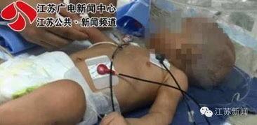 儿童烧伤图片,关爱与救治的紧急行动