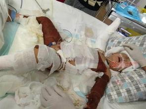 儿童烧伤图片,关爱与救治的紧急行动  第2张