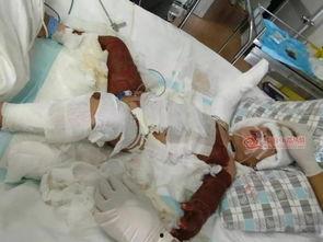 儿童烧伤图片,关爱与救治的紧急行动  第3张
